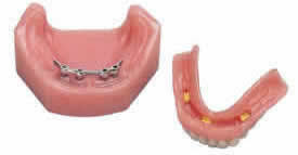 Implant denture bar 2